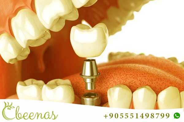 implantes dentales en turquía opiniones