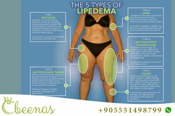 Relief and Renewal: Lipedema Liposuction in Turkey