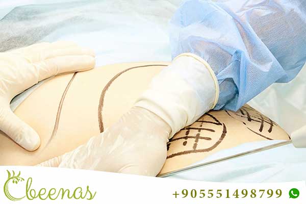 liposuction istanbul: Sculpting Your Body with Precision