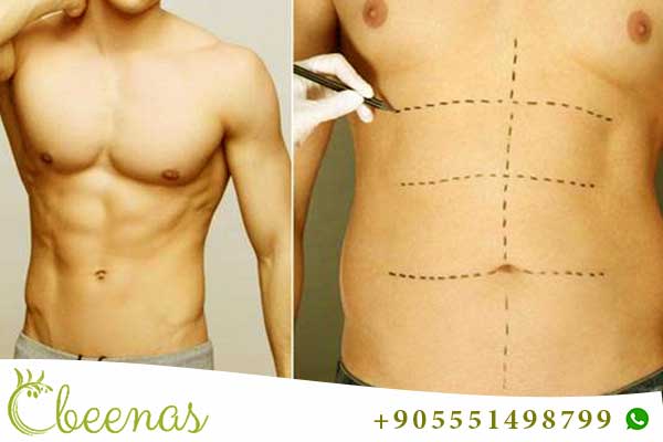 Seamless Transformation: Liposuction in Turkey – All-Inclusive Packages
