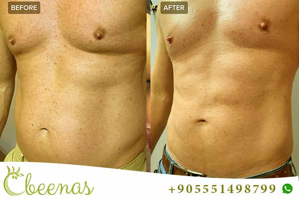 Transformative Journey: Liposuction in Turkey – Before and After