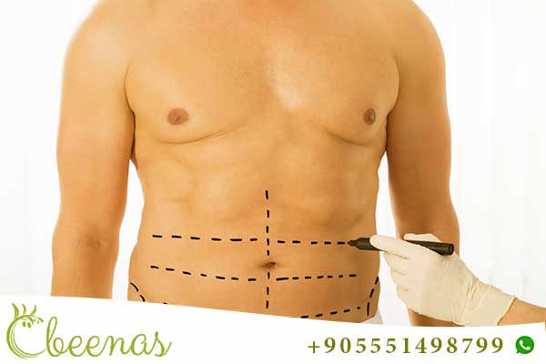 liposuction turkey packages