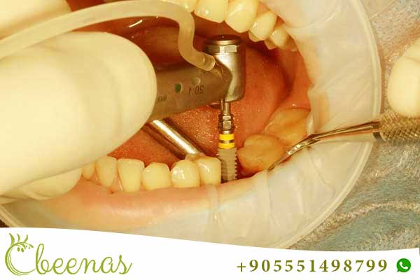 Precio de Implantes Dentales en Estambul: Calidad Odontológica en la Encrucijada de Dos Continentes