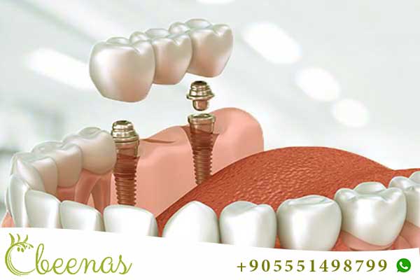 precio implantes dentales para toda boca turquía