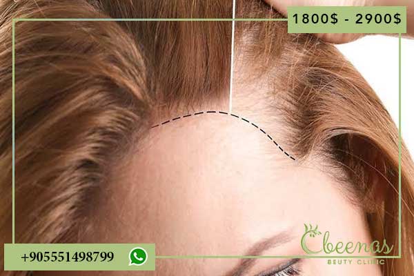 Unlocking Positive Feelings: 10 Reasons Why the best hair transplant in turkey price