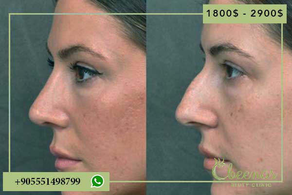 Discover the 7 Best Nose Job Surgeon in Turkey for Positive Results