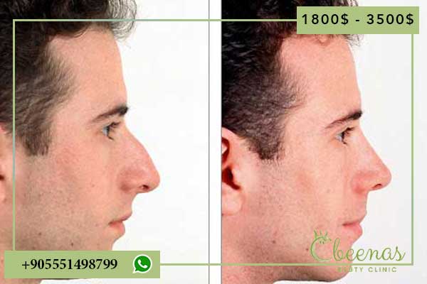 Top 7 Best Nose Surgeons in Turkey: Positive Outcomes Guaranteed