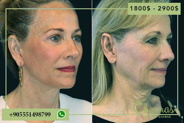 7 Reasons Why face surgery in turkey Brings Positive Feelings and Confidence