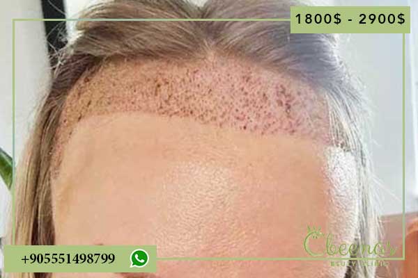 good hair transplant turkey: 10 Reasons for Positive Results