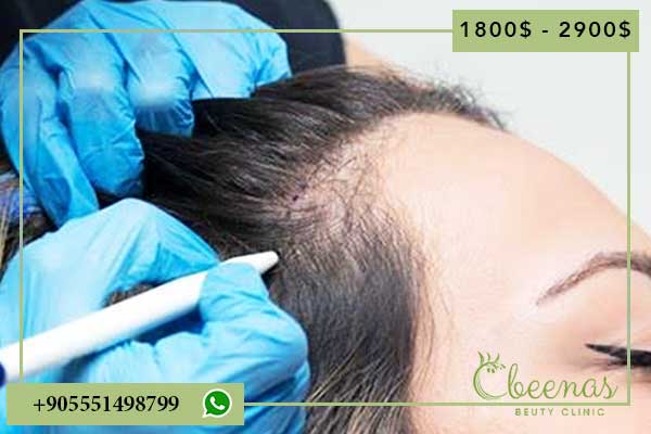 The Top 5 Benefits of Hair Implant Surgery Turkey: Avoid Negative Feelings About Hair Loss