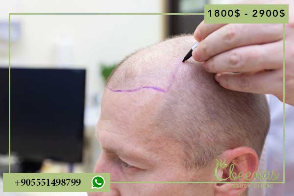 Hair Transplant in Turkey Reviews: 7 Reasons for Positive Feelings