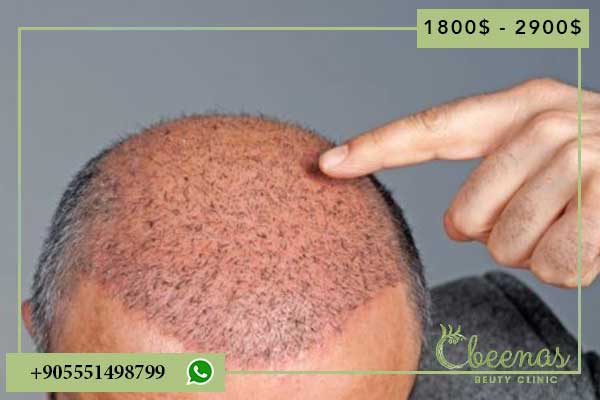 Hair Transplant Surgery Cost Turkey: 5 Reasons for Positive Results