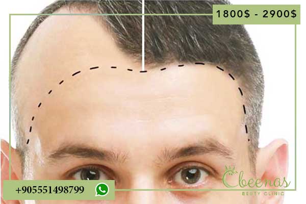 hairline transplant turkey cost and Positive Outcomes