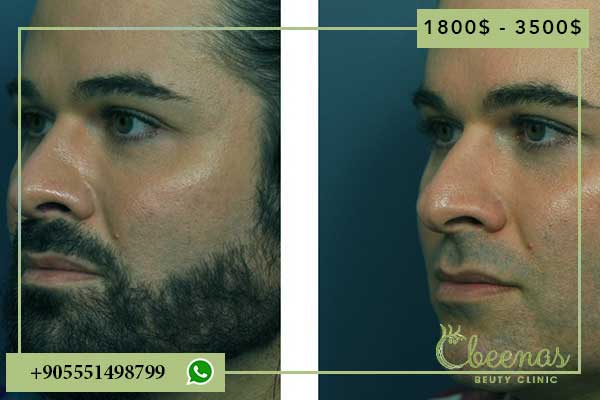 Nose Job Price Turkey: 7 Positive Reasons to Choose Laviva Clinic for Your Transformation