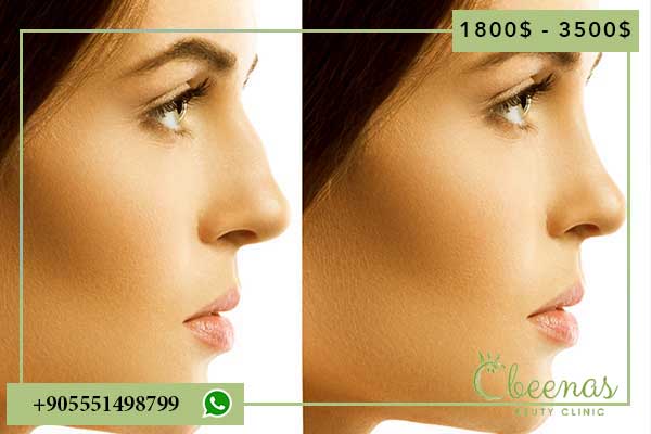 Discover the Top 7 Reasons to Consider nose surgery cost turkey