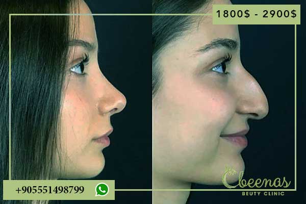 10 Benefits and nose surgery in turkey cost: A Complete Guide to Positive Results