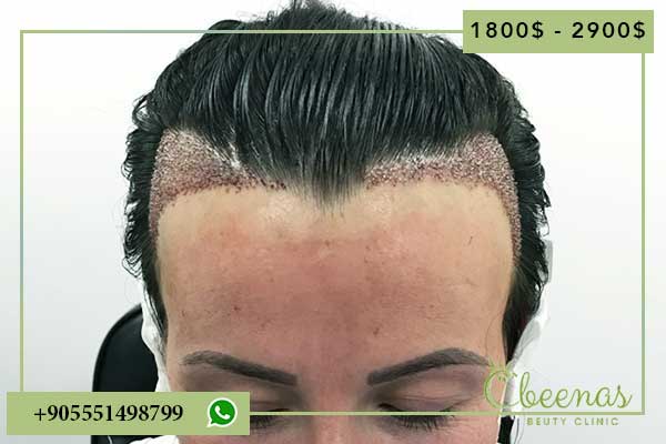 Price of Hair Transplant Turkey: 10 Positive Reasons to Choose Laviva Clinic