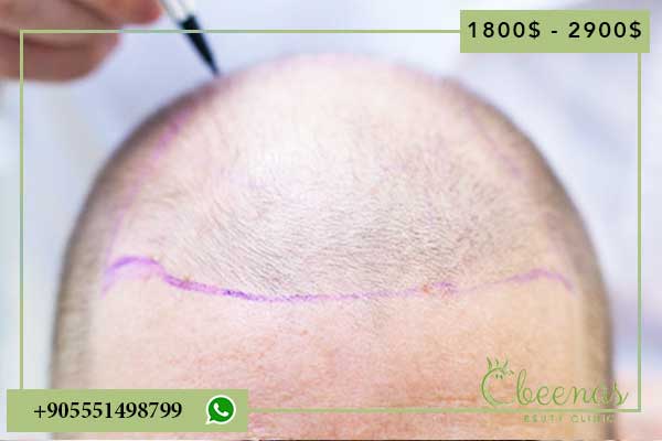 5 top rated hair transplant in turkey That Will Change Your Life