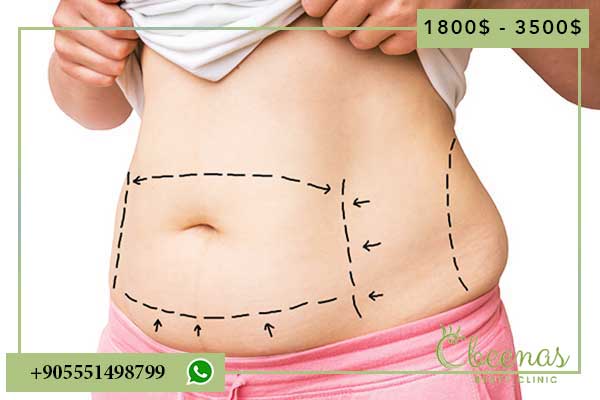 Tummy Tuck Price Turkey: 5 Positive Reasons to Consider This Affordable Option