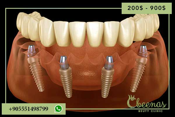 Positive and Negative Feelings About Turkey Dentist Prices: A Comprehensive Guide