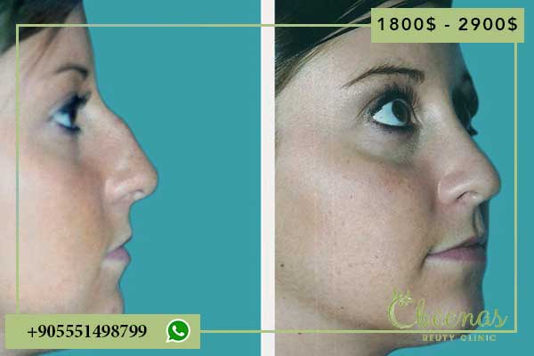 Turkey Nose Surgery Cost: Why You’ll Have Positive Feelings About This Investment