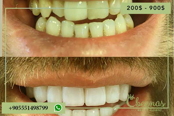 Turkey Teeth Before and After: 7 Positive Transformations That Will Amaze You