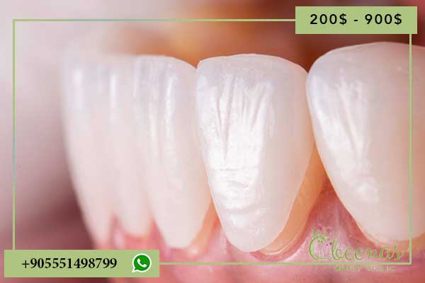 veneers in turkey cost: 7 Key Factors Influencing Cost and Quality