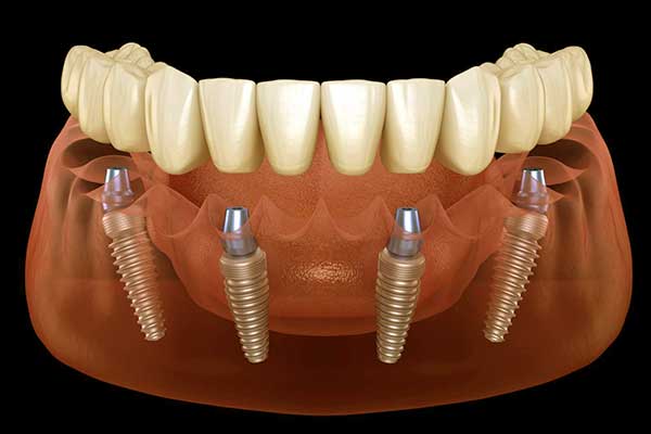 Implantes Dentales en Turquía: Recupera tu Sonrisa con Innovación y Cuidado