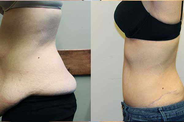 how much weight can you lose with cool sculpting ? Your Comprehensive Guide