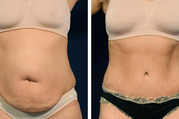 Does CoolSculpting Tighten Belly Skin? Exploring the Real Effects and Alternatives