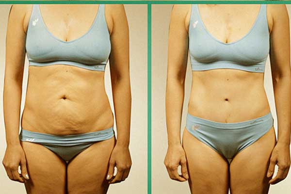 How Many Inches Can CoolSculpting Remove? A Comprehensive Guide