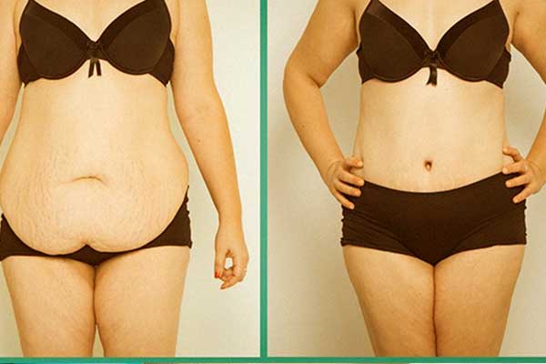 what is the downside of coolsculpting? The Comprehensive Guide You Need to Know