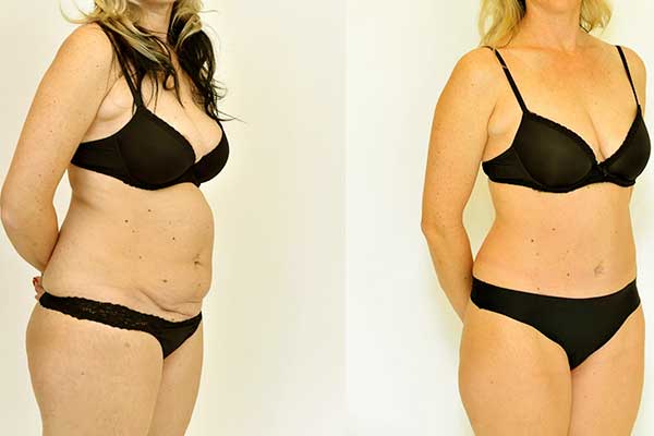 Is CoolSculpting Cheaper Than Liposuction? A Comprehensive Guide to Making the Right Choice