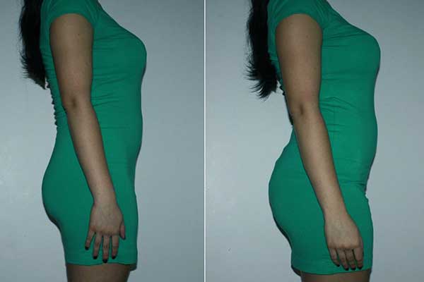 Does Skin Sag After CoolSculpting? A Full Guide to Avoiding Sagging & Achieving Smooth Results