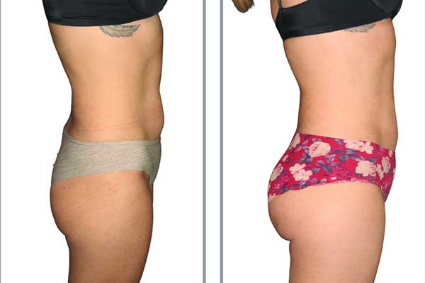 does coolsculpting reduce waist size ? A Complete Guide to Fat-Freezing Success