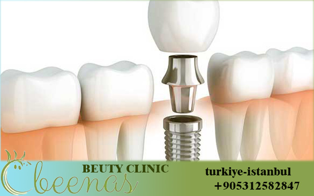 best implant dentist in istanbul turkey