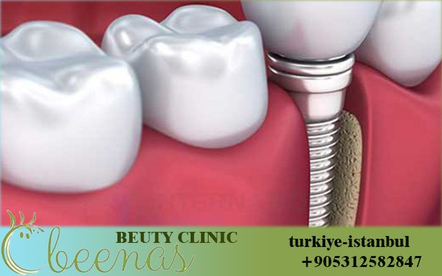 Best Dental Implants in Istanbul Turkey