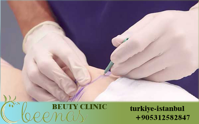 Air Sculpting in Turkey: 11 Powerful Reasons People Choose It in 2026 – Ready for a New Shape?