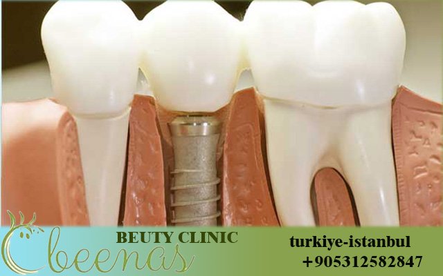 Best Dental Implants Turkey Cost 2026