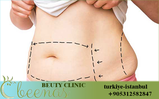 Flex Sculpt in Turkey 2026