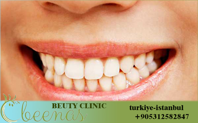 Dental implants in Turkey